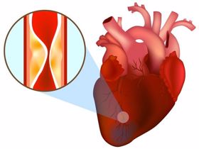Bệnh nhồi máu cơ tim - “Kẻ giết người” nhanh và nguy hiểm!